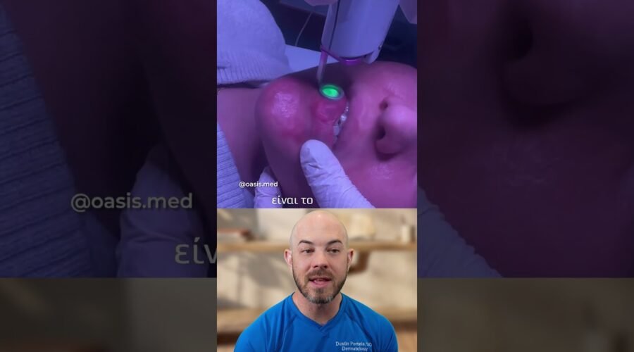 Laser Treatment for a Chin and Lip Port Wine Stain